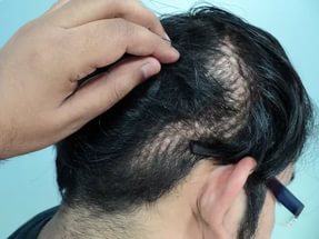 عملية زراعة الشعر الطبيعي