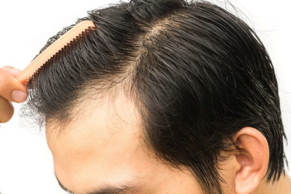 تكلفة زراعة الشعر في الامارات