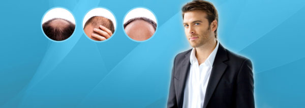 تكلفة زراعة الشعر في تركيا و الدول الغربية