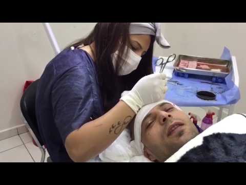 زراعة الشعر في الدول العربية وجميع انحاء العالم