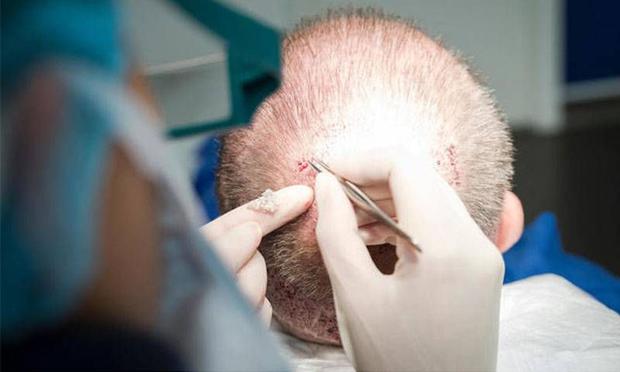 زراعة الشعر بدون جراحة