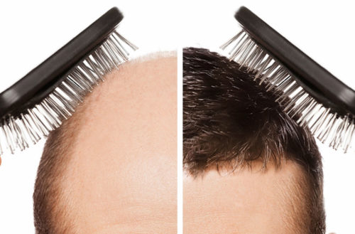 كم تكلفة عملية زراعة الشعر في جدة؟
