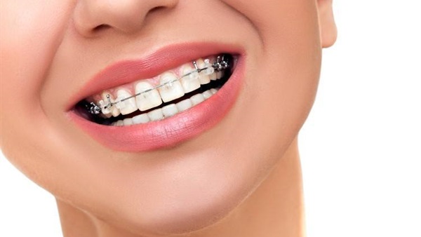 أبرز مشاكل تقويم الأسنان