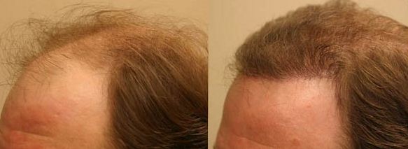 مراحل نمو الشعر بعد الزراعة بالصور