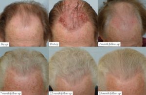 مراحل نمو الشعر بعد الزراعة بالصور