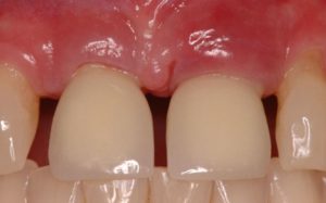 التهاب اللثة بعد زراعة الاسنان