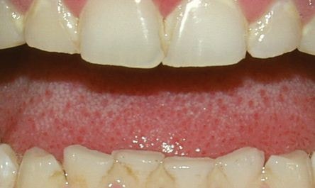 امراض الاسنان بالصور