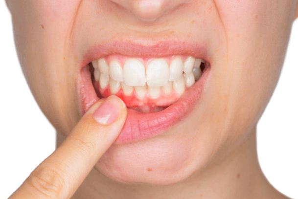 التهاب اللثة بعد زراعة الاسنان