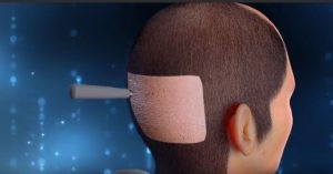 تجارب زراعة الشعر بتقنية DHI في مصر