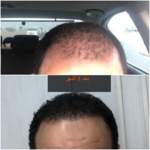 صور زراعة الشعر قبل وبعد في مصر